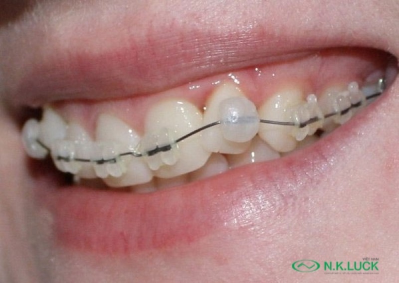 Tìm hiểu công dụng của sáp nha khoa