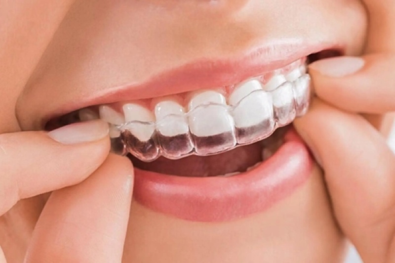 Niềng răng Invisalign Niềng răng trong suốt