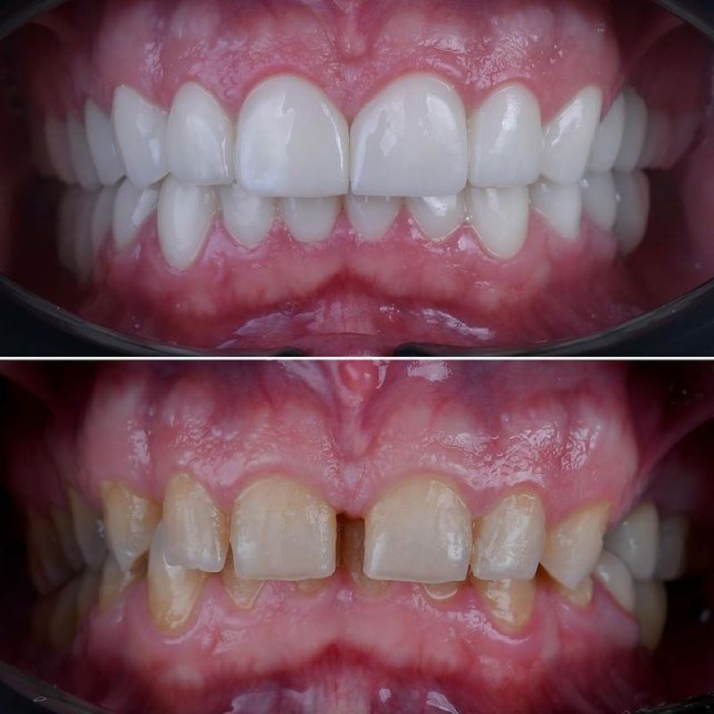 Vị trí răng cần mài răng bọc sứ ở đâu?