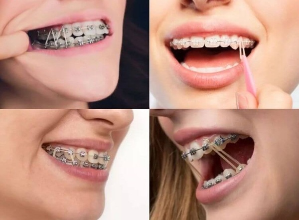 Có 3 loại dây thun liên hàm được sử dụng phổ biến Có 3 loại dây thun liên hàm được sử dụng phổ biến