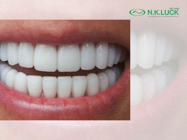 Vệ sinh cẩn thận sau khi bọc răng sứ không mài