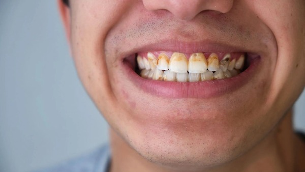 Không lấy cao răng định kỳ có thể dẫn đến nhiều vấn đề về sức khỏe răng miệng Không lấy cao răng định kỳ có thể dẫn đến nhiều vấn đề về sức khỏe răng miệng