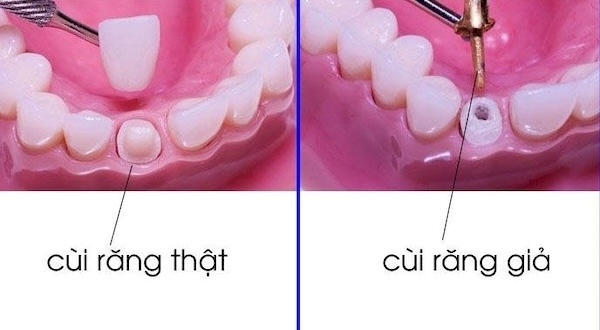 Gắn răng tạm thời giúp bảo vệ cùi răng khỏi các yếu tố gây hại