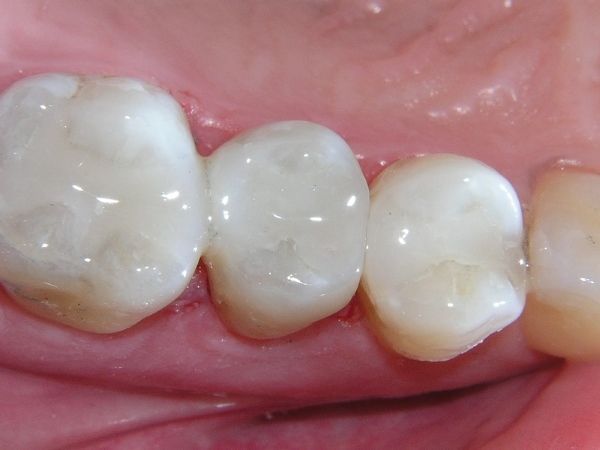 Trám răng tạm thời bằng Composite Trám răng tạm thời bằng Composite