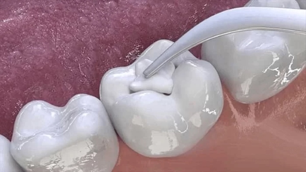 Trám răng tạm thời bằng Glass Ionomer Cement Trám răng tạm thời bằng Glass Ionomer Cement