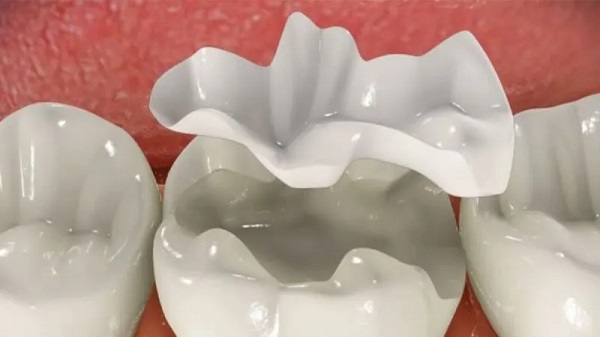 Trám răng tạm thời bằng sứ Trám răng tạm thời bằng sứ