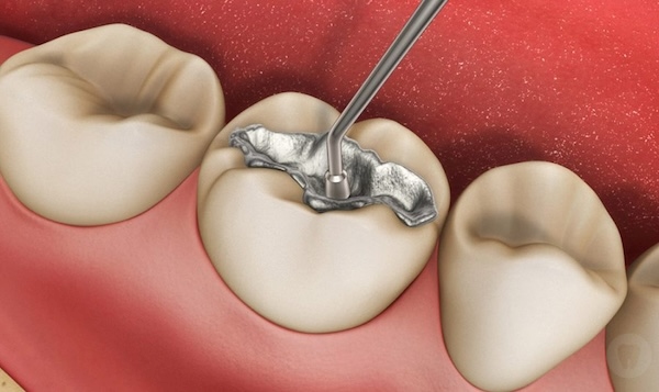 Trám răng tạm thời bằng kim loại Amalgam Trám răng tạm thời bằng kim loại Amalgam