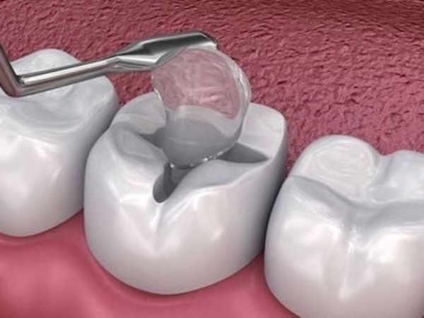 Trám răng tạm thời có bền hay không? Trám răng tạm thời có bền hay không?