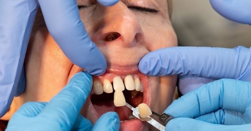 Nên lựa chọn giữa keo dán răng sứ hay dán sứ thẩm mỹ