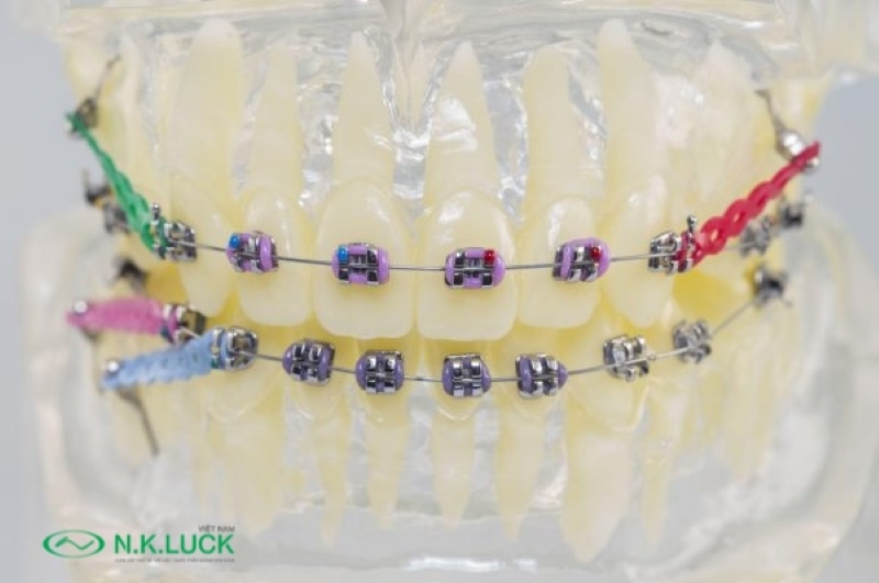 Chun chuỗi là khí cụ kết nối liên kết các răng trong cùng một hàm