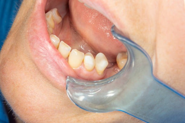 Các thiết bị cần thiết để đo độ vững ổn Implant trong Nha Khoa