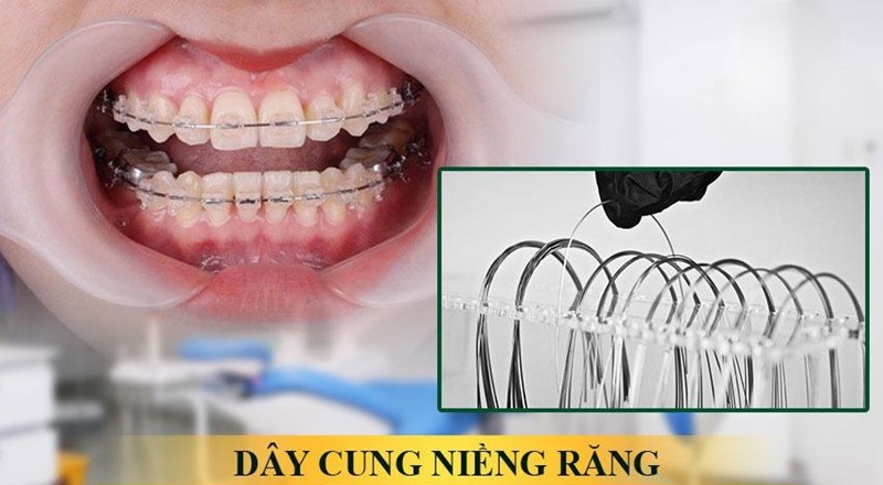 Dây cung được xem là khí cụ không thể thiếu trong niềng răng Dây cung được xem là khí cụ không thể thiếu trong niềng răng