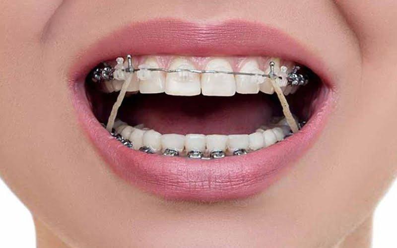 Dây chun liên hàm có độ đàn hồi cao và được sử dụng phổ biến trong điều trị chỉnh nha Dây chun liên hàm có độ đàn hồi cao và được sử dụng phổ biến trong điều trị chỉnh nha