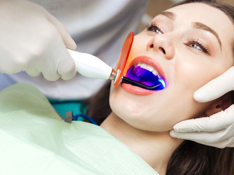 Tìm hiểu khái niệm trám răng Composite Tìm hiểu khái niệm trám răng Composite