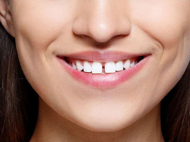 Các trường hợp nào có thể trám răng thẩm mỹ Composite Các trường hợp nào có thể trám răng thẩm mỹ Composite