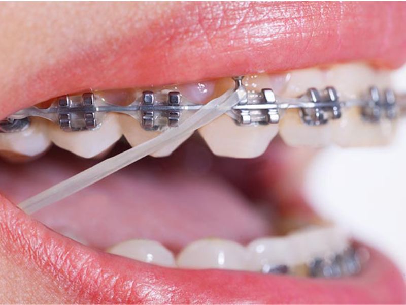 Tác dụng khi đeo chun liên hàm Tác dụng khi đeo chun liên hàm