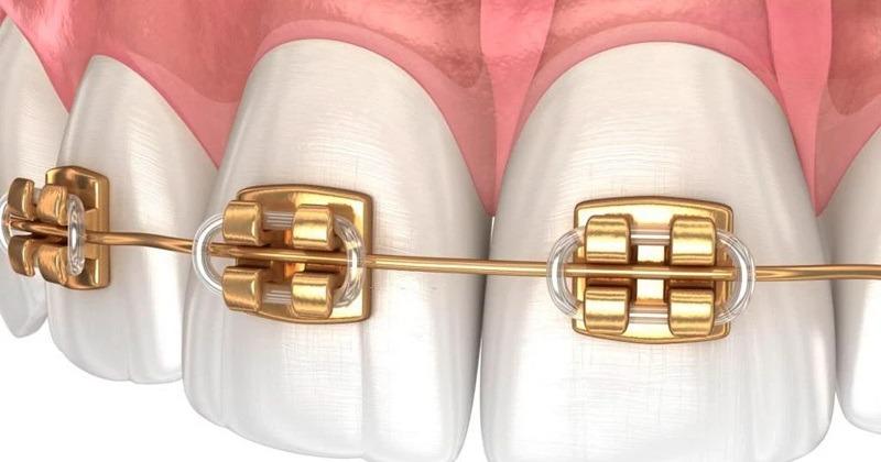 Dây cung niềng răng được chế tạo từ hợp kim kim loại quý Dây cung niềng răng được chế tạo từ hợp kim kim loại quý
