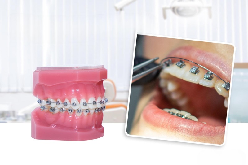 Đeo dây niềng răng có đau không? Đeo dây niềng răng có đau không?