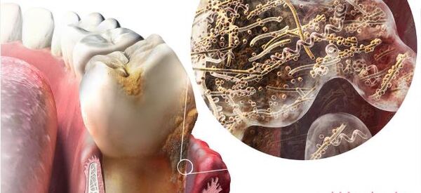 cạo vôi và đánh bóng răng