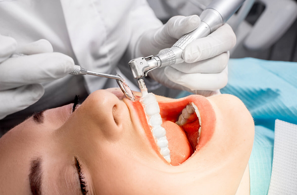 cạo vôi và đánh bóng răng