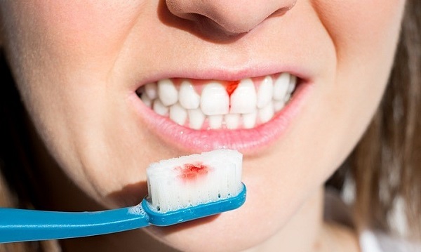 Chải răng quá mạnh cũng là nguyên nhân gây sưng nướu Chải răng quá mạnh cũng là nguyên nhân gây sưng nướu
