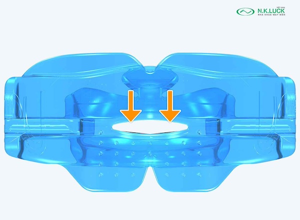 myobrace for kid K0 sau