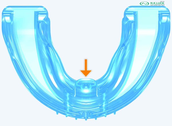 myobrace for kid K1 sau