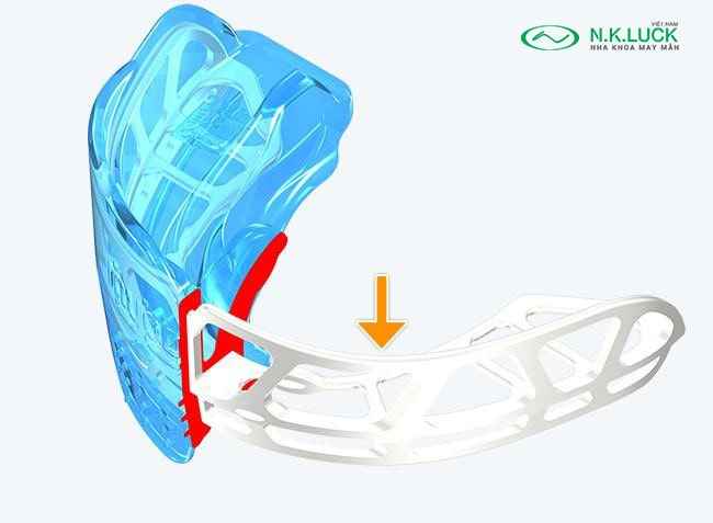 myobrace for kid K2 sau