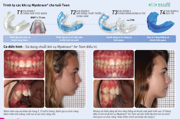 trình tự khí cụ myobrace for teen