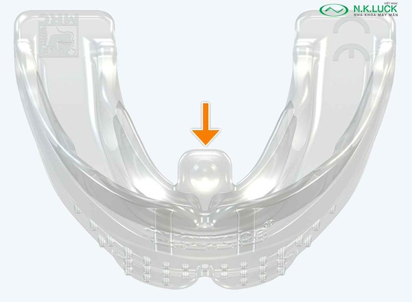 myobrace for teen T1 sau