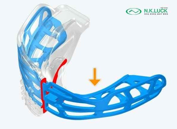 myobrace for teen T2 sau
