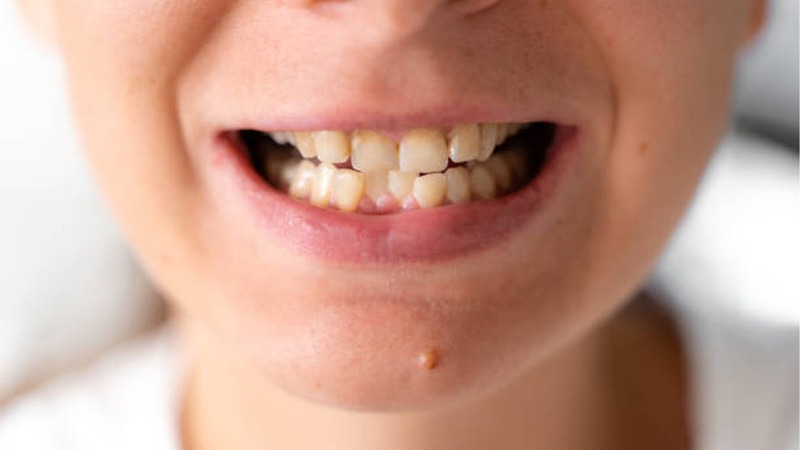 Răng khấp khểnh gây khó khăn trong quá trình vệ sinh răng miệng hàng ngày Răng khấp khểnh gây khó khăn trong quá trình vệ sinh răng miệng hàng ngày