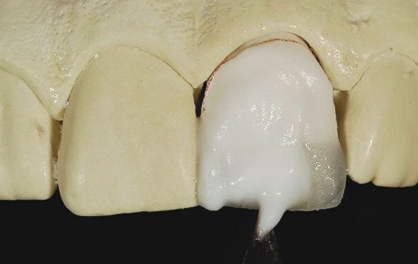 Đắp sứ dạng bột và nước lên răng Đắp sứ dạng bột và nước lên răng